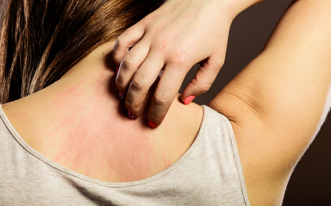 Sanitizers and Cleaning Products May Be Causing Your Itchy, Dry Skin