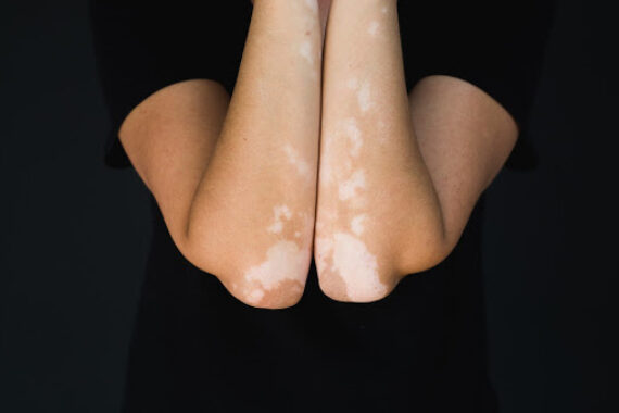 Sanitizers and Cleaning Products May Be Causing Your Itchy, Dry Skin