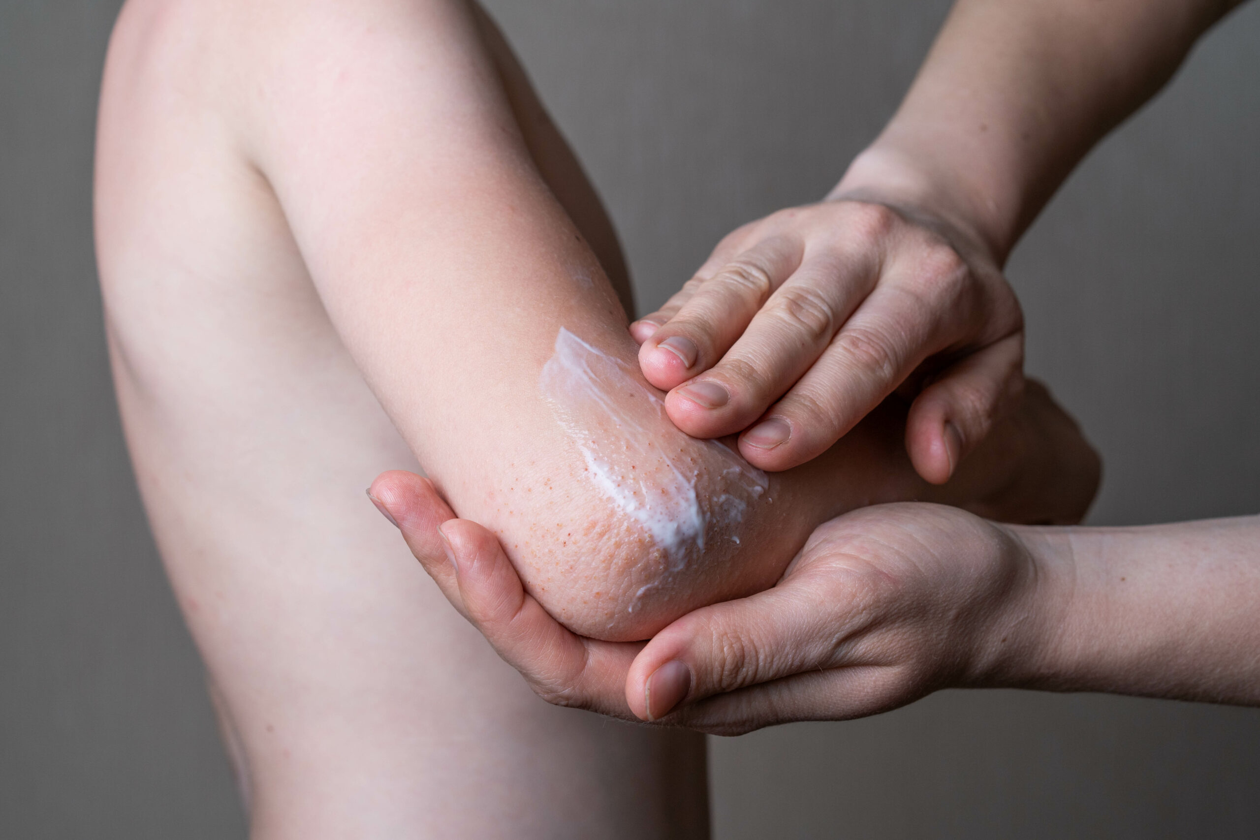 Eczema Treatments: From Topicals to Therapies—What Works?